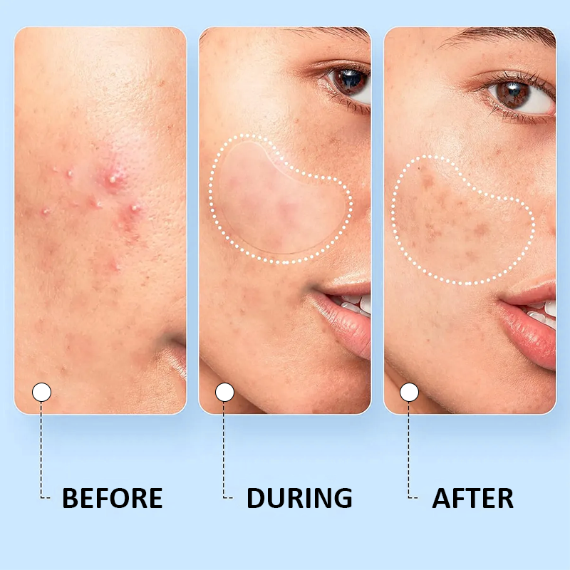 ✨ Multi-Size Acne Patch Set